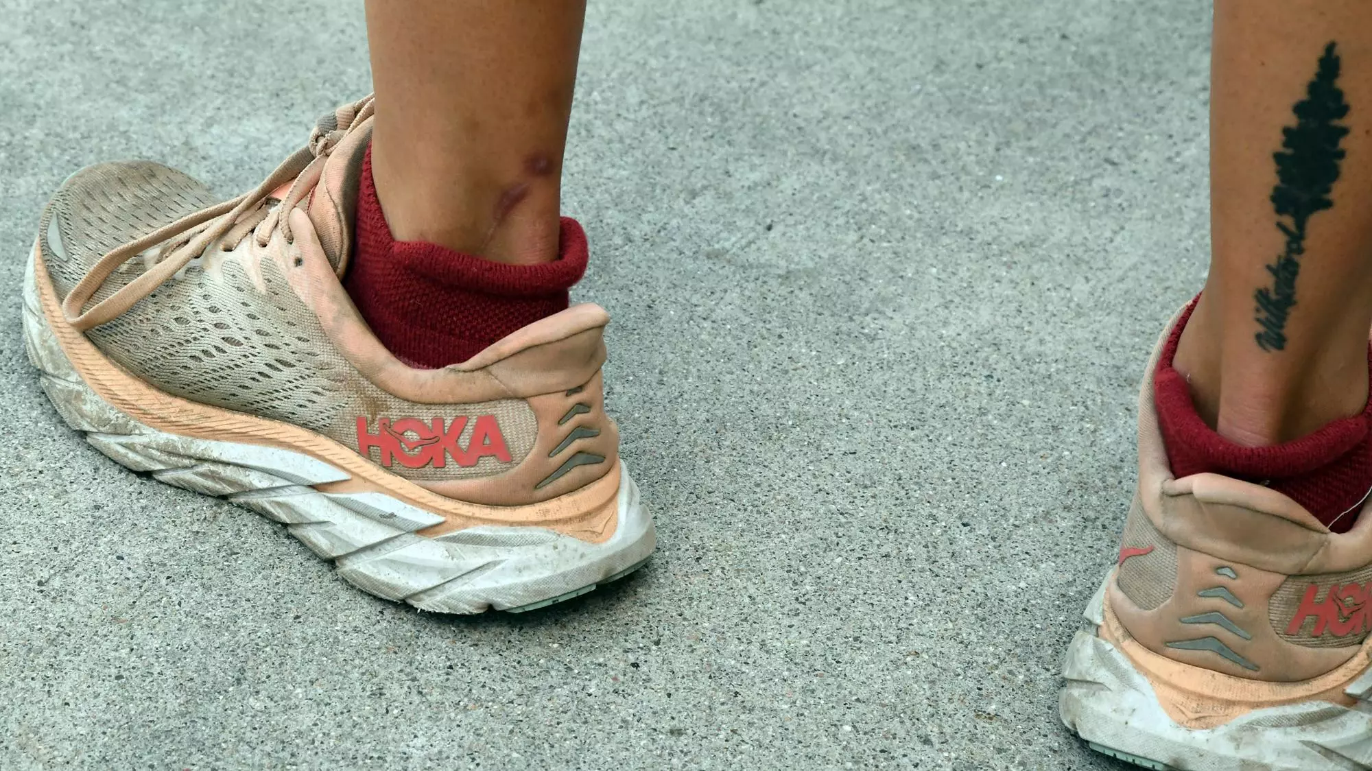 Lily Tomasula-Martin scar