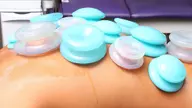 Lopes student-athletes familiar with cupping