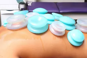 cupping