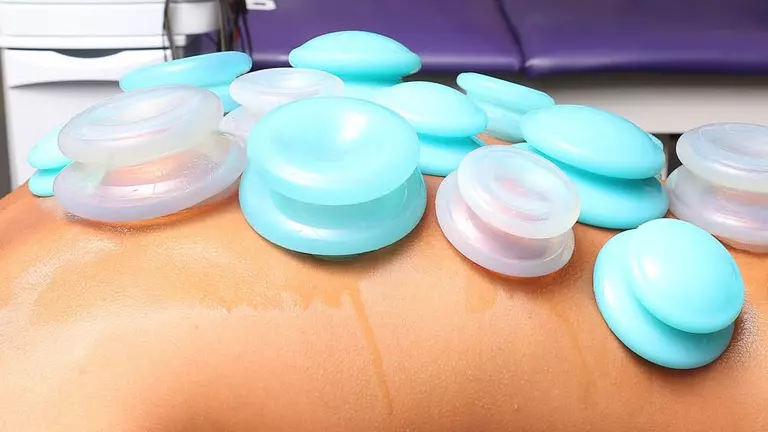Lopes student-athletes familiar with cupping