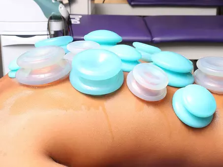 cupping