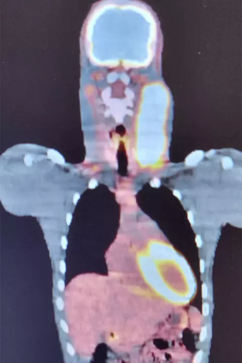 Myles Rice's cancer scan